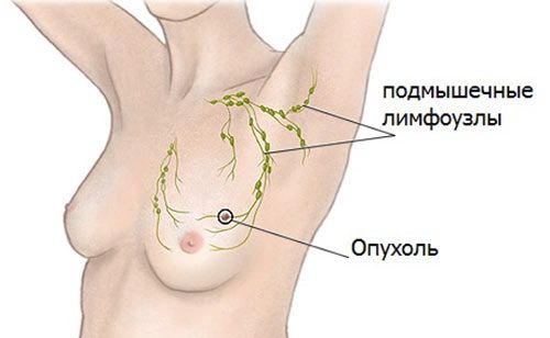 Как лечить лимфоузел под мышкой народные средства Как лечить лимфоузел под мышкой народные средства