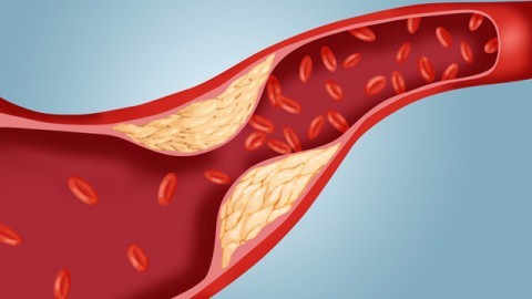 Излишки холестерина на внутренней стенке кровеносных сосудов