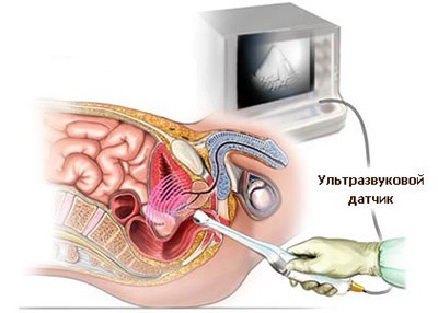 Трансректальное ультразвуковое исследование
