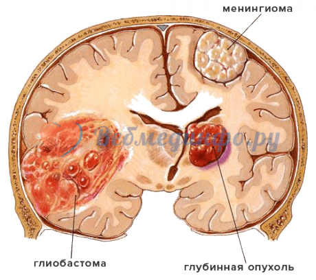 Виды опухолей головного мозга