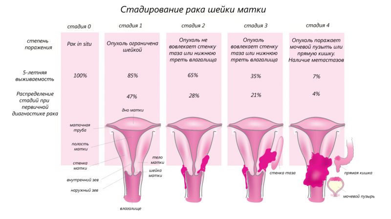 Как лечить начальную стадию рака шейки матки Как лечить начальную стадию рака шейки матки