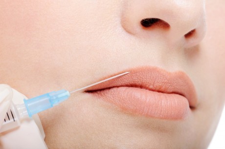 Инъекции гиалуроновой кислоты для коррекции формы губ