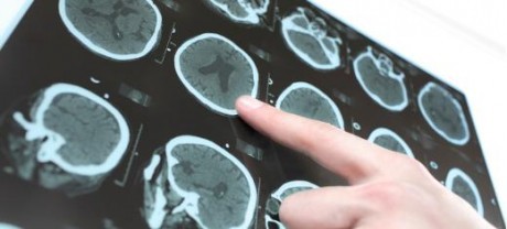 Исследователи обнаружили механизм, связанный с повреждением головного мозга после перенесенного инсульта, а теперь разрабатывают препарат, чтобы заблокировать его.