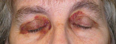 Кровоизлияния около глаз один из симптомов амилоидоза.