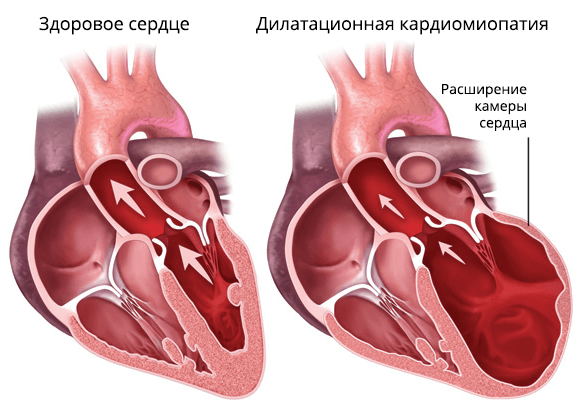 Дилатационная кардиомиопатия