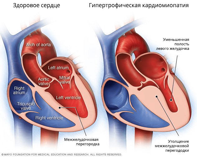 Основной признак гипертрофической кардиомиопатии
