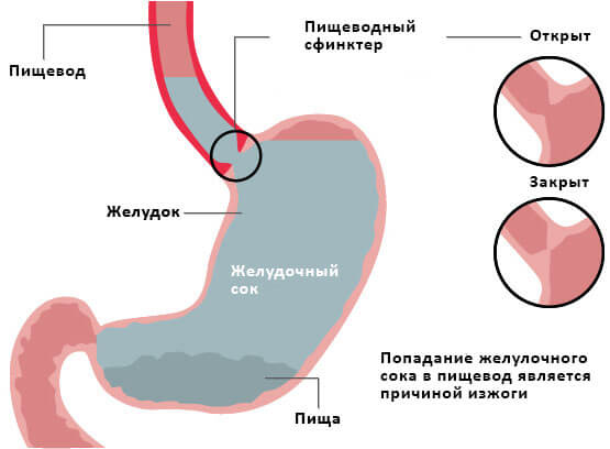 Как избавится от изжоги в домашних условиях и быстро Как избавится от изжоги в домашних условиях и быстро
