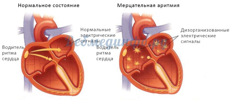 Различия в генерации электрических импульсов при здоровом сердце и мерцательной аритмии