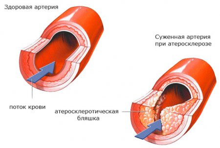 Основная причина возникновения нестабильной стенокардии — атеросклеротические бляшки в венечных артериях.