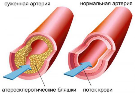 Сужение артерий - атеросклероз - основная причина возникновения стенокардии