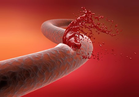 Гемофилия - наследственное заболевание, связанное с нарушением процессом свёртывания крови