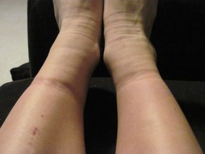 Одна из причин отечности ног - варикозная болезнь нижних конечностей