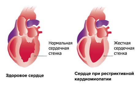 Вид стенки желудочка при рестриктивной кардиомиопатии